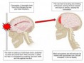 /album/concussion-injury-/concussions-jpg/